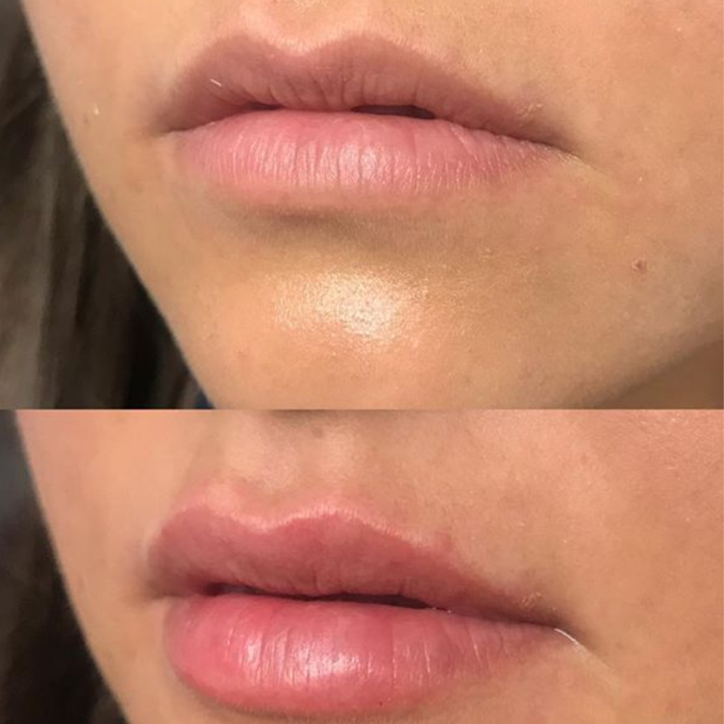 catalyst fargo lip fillers before and after 1