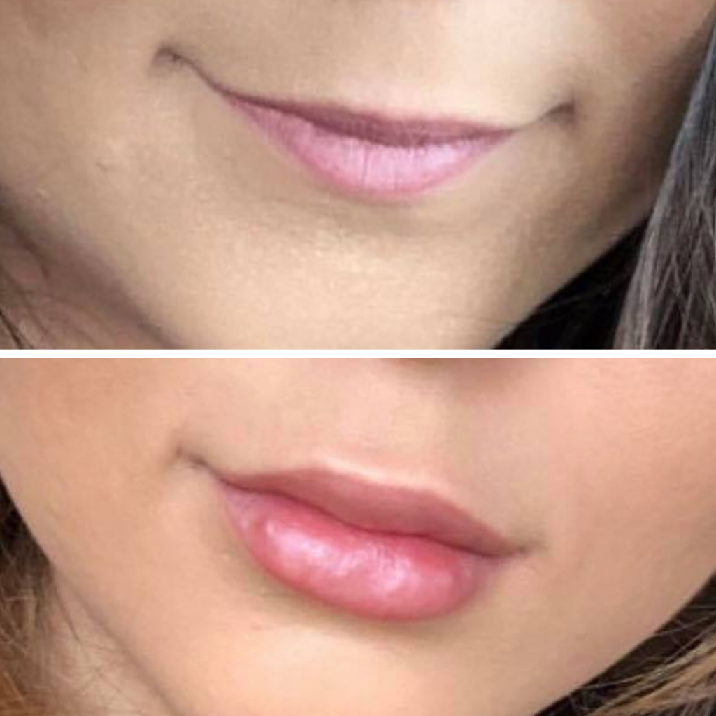 catalyst fargo lip fillers before and after