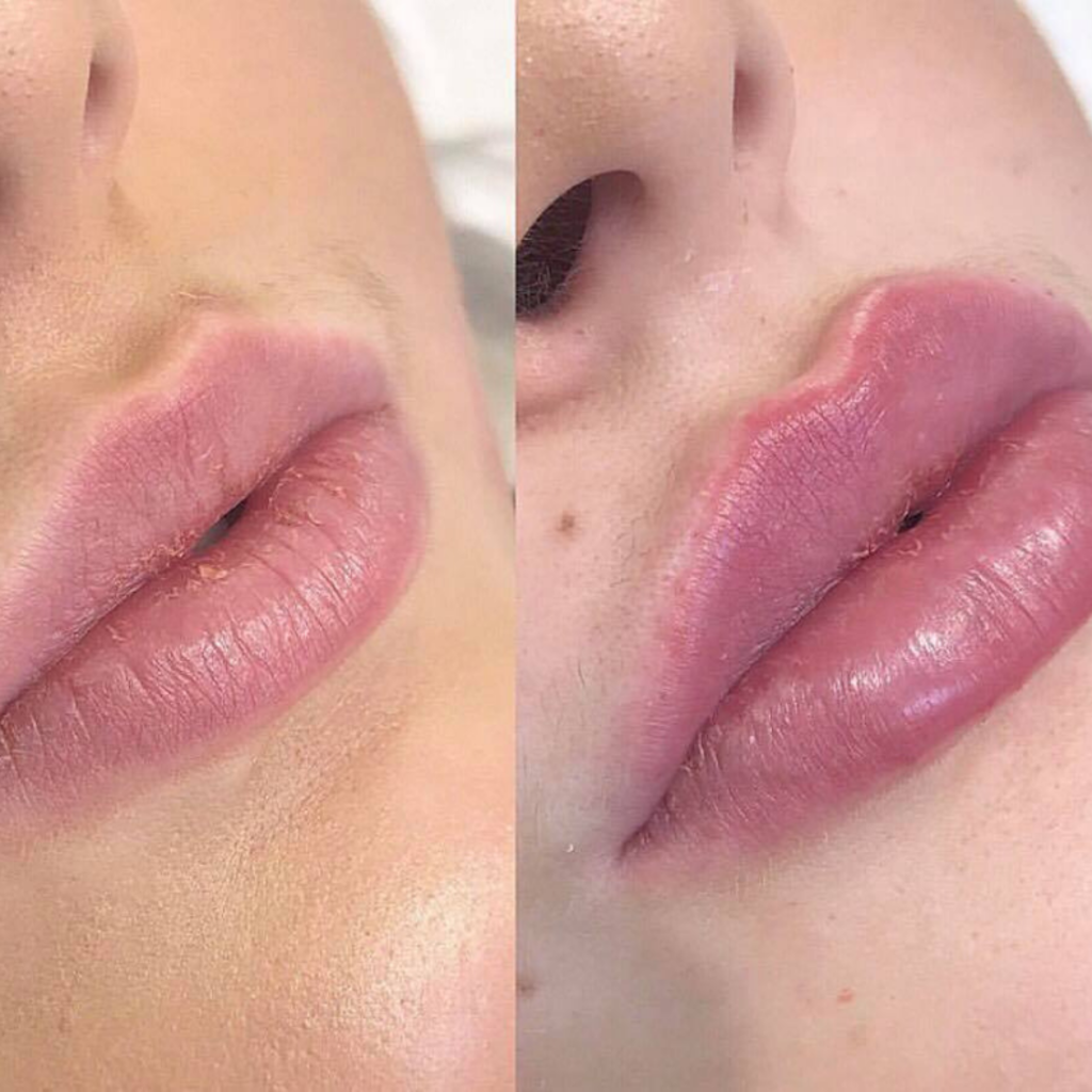catalyst fargo lip fillers before and after 2