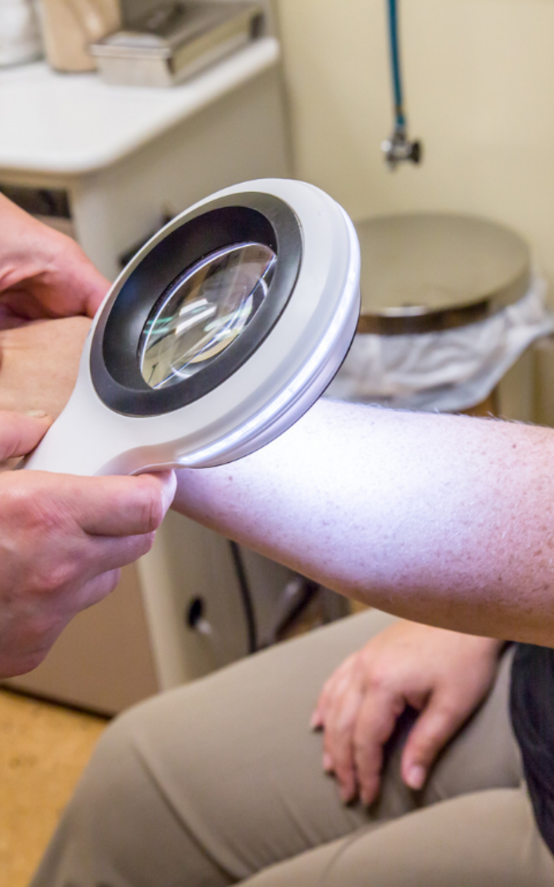 catalyst fargo melanoma magnifying glass