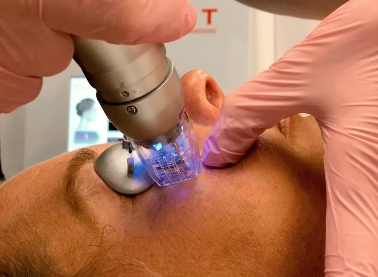Microneedling offers a minimally invasive option for stimulating collagen, tightening skin, and reversing sun damage.