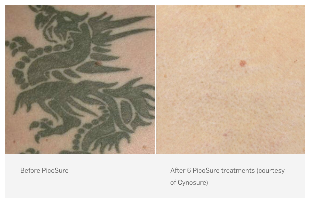 Picosure Tattoo Removal before and after photo