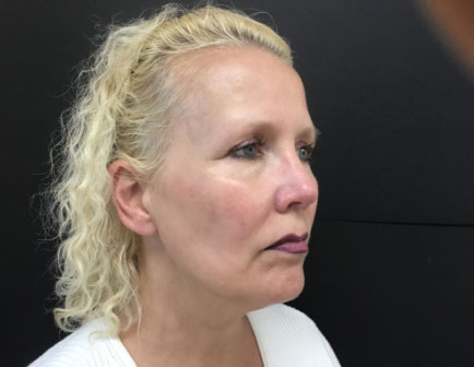NONSURGICAL FACELIFT SIDE ANGLE AFTER NONSURGICAL FACELIFT SIDE ANGLE AFTER