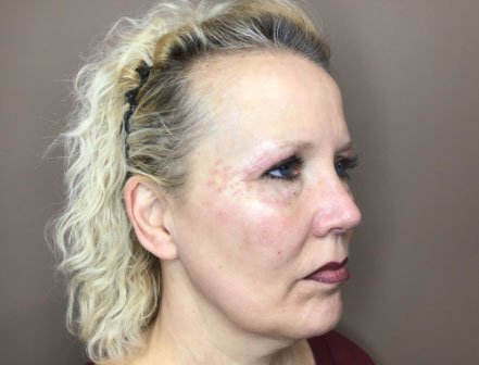 nonsurgical facelift side angle before