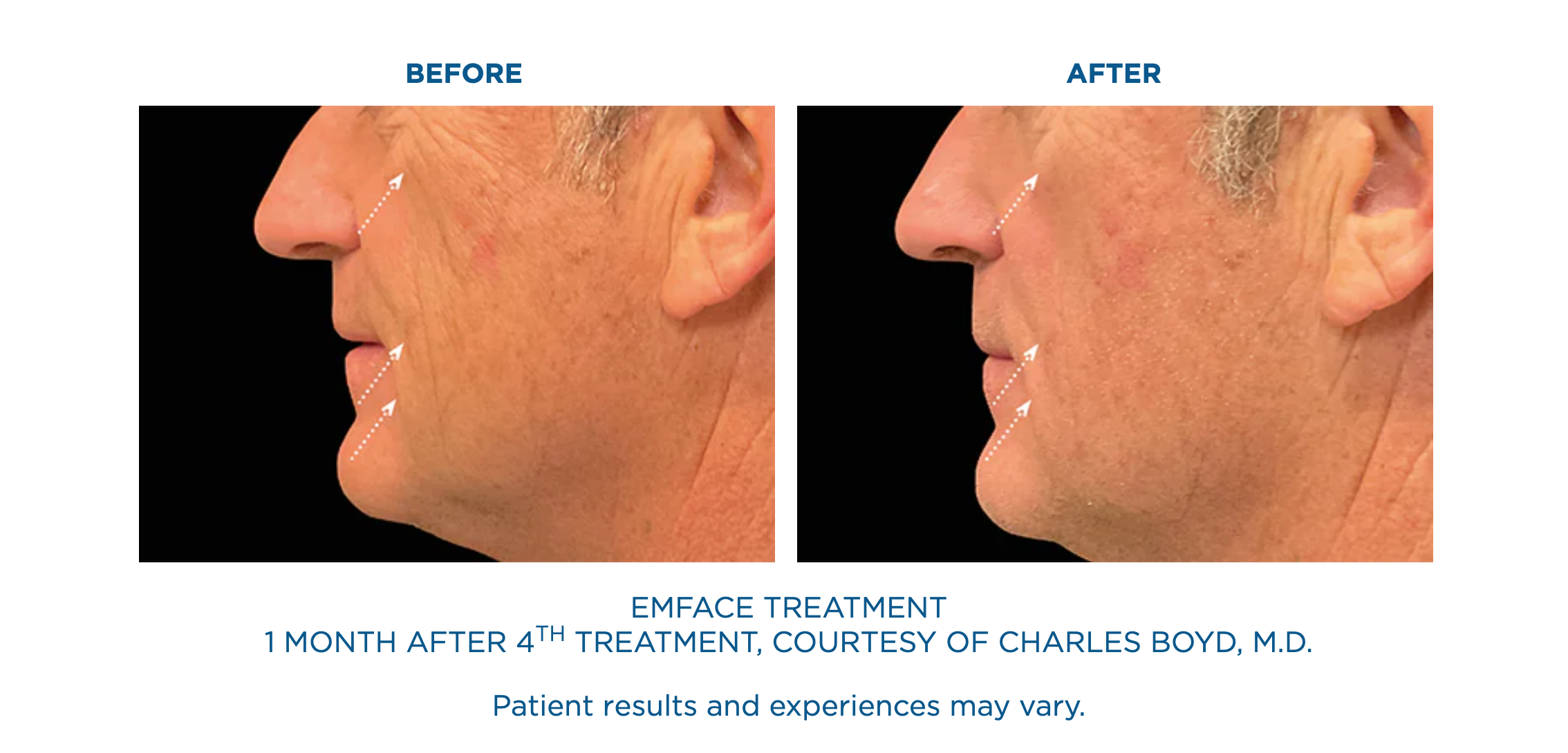 emface cheeks before and after emface cheeks before and after