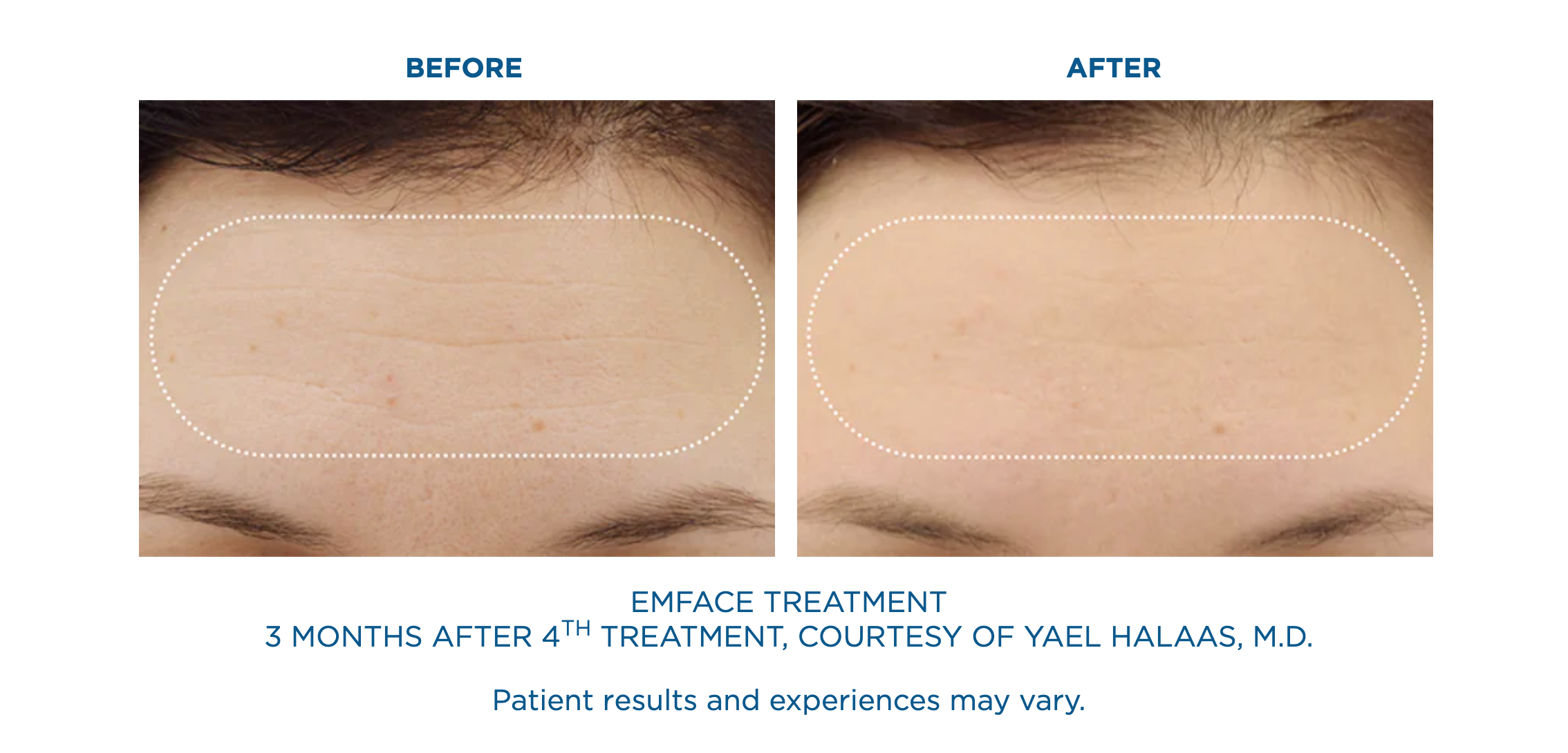 emface forehead before and after
