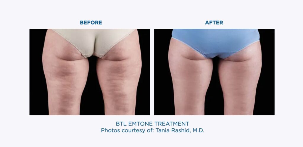 BTL-EMTONE-Underthigh-Treatment