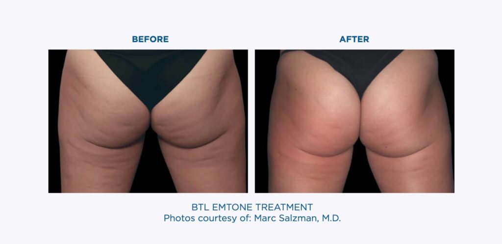 BTL-Emtone-Buttocks-Treatment