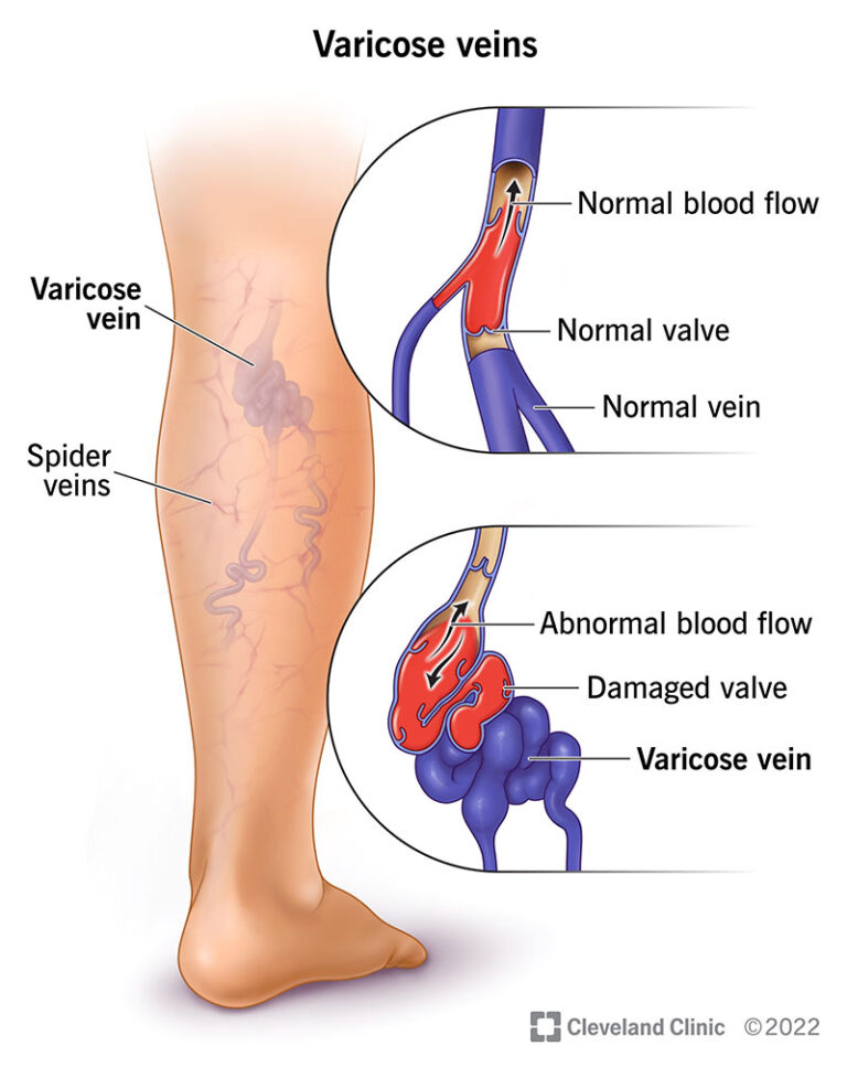 An illustration displaying Varicose veins, spider veins, and how they form.
