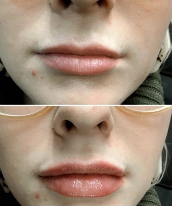 Catalyst Clinical Spa Lip Filler Fargo Before and after