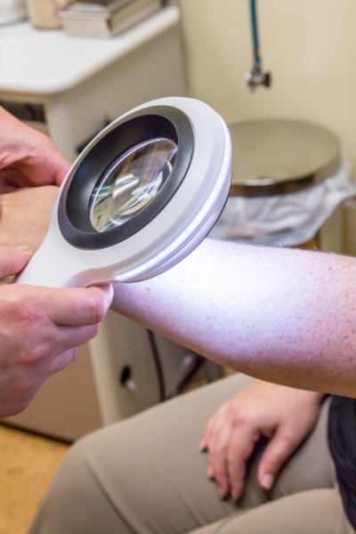 catalyst fargo melanoma magnifying glass